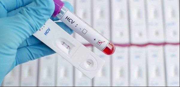 Hepatitis C: prevención y tratamiento según expertos