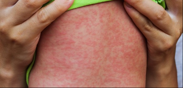 Alarmante: por los antivacunas aumentan los casos de sarampión en el mundo un 20 por ciento