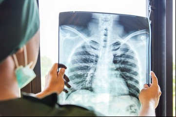 Lanzan una nueva droga contra el cáncer de pulmón en Argentina