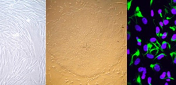 Hito argentino: transforman células de la piel en neuronas para combatir un tipo de epilepsia