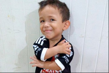 La ANMAT autorizó en el país una droga contra el enanismo y se abre una esperanza para muchas familias