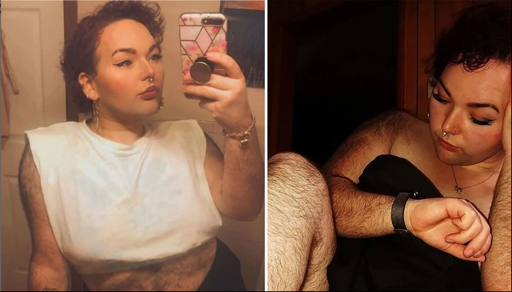 Samantha Allen padece hirsutismo y denuncia que es acosada en las redes.