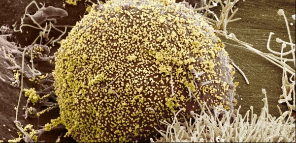 Una mujer se curó de VIH con un novedoso tratamiento con la sangre del cordón umbilical