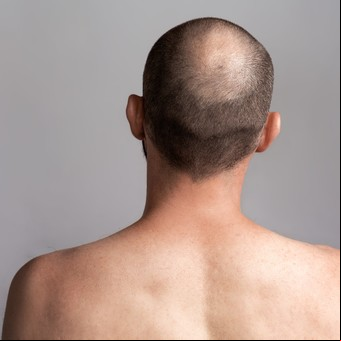 Qué vitaminas hay que tomar para evitar la caída del cabello