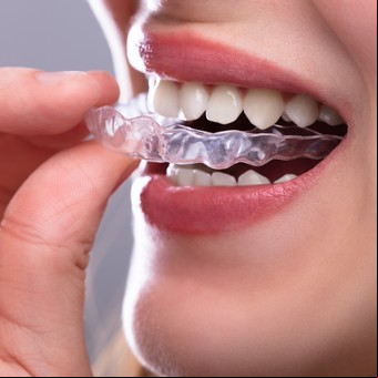 ¿Apretás los dientes? Por qué la placa de descanso no es la solución definitiva al bruxismo