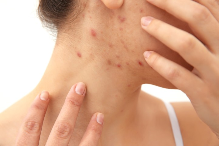 El tan molesto acné, no solo un problema de estética. Foto Shutterstock.