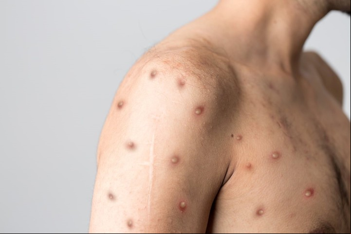 Las lesiones pueden ser pocas o muchas y ubicarse en la piel o las mucosas. Foto: UK Health / Monkeypox Rash Photos