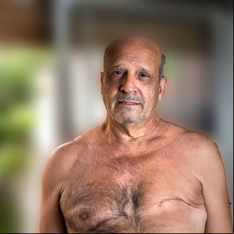 El cáncer más impensado que diagnostican a 220 argentinos cada año