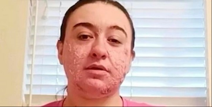 "La hidradenitis superativa es una plaga", afirma contundente la mujer de 24 años.