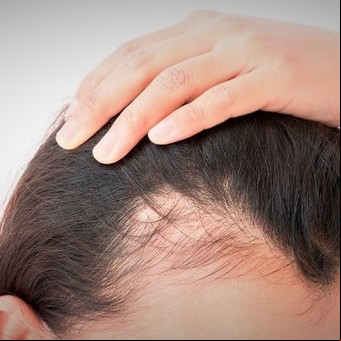Qué vitaminas se recomienda tomar para evitar la caída del cabello
