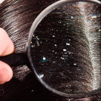 El eficaz método para eliminar la caspa del pelo, según la Universidad de Harvard