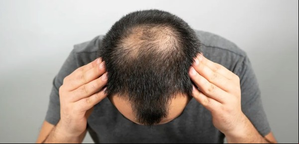 Crecen las consultas por la caída del pelo en hombres y un recurso para frenarla