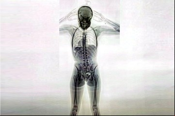 La impresionante imagen de una "mula" detenida en Ezeiza con 78 cápsulas de cocaína en el cuerpo