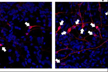 La ciencia trae dos buenas noticias para el tratamiento del Parkinson con células madre: seguridad y eficacia