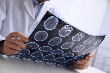 Alzheimer: nuevos avances para su detección temprana