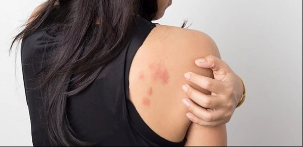 ¿Qué puede provocar alergia en todo el cuerpo?