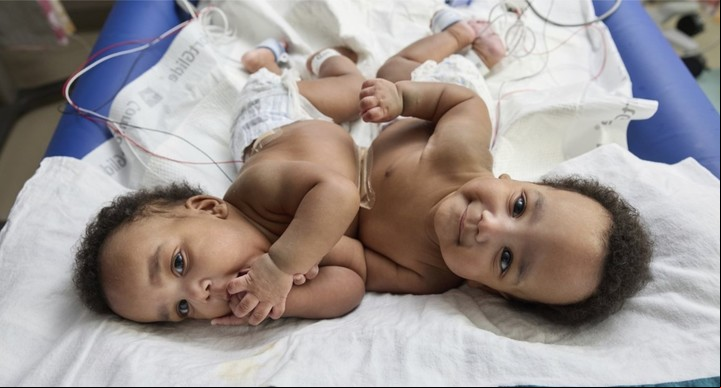Entre los dos pesaban un total de 2,7 kilogramos (Children’s Hospital of Philadelphia).