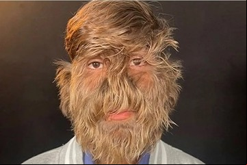 Es muy feliz así: el adolescente que tiene el síndrome del hombre lobo