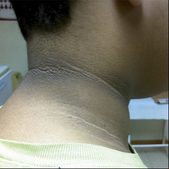Cuello oscuro: qué significa y cuándo puede ser una señal de alerta