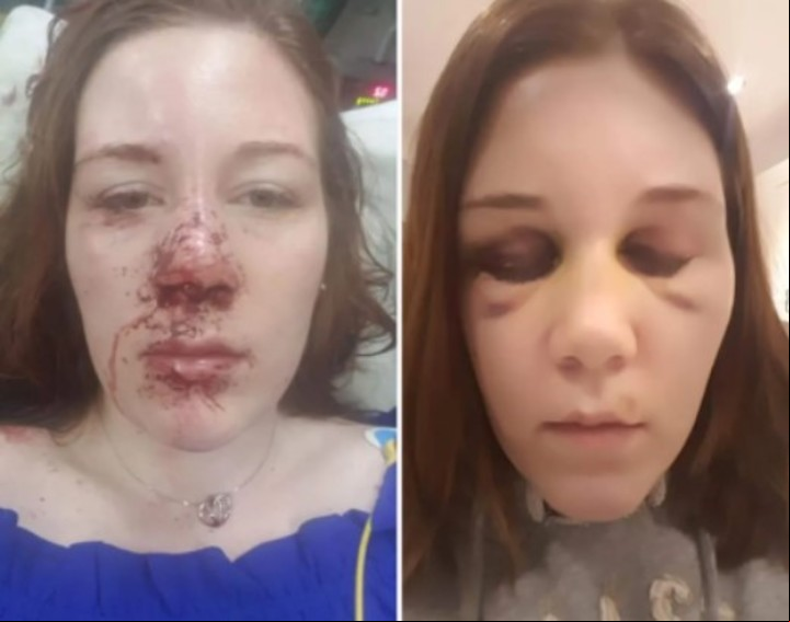 Emma Evens sufrió muchas lesiones producto de las convulsiones a lo largo de los años.