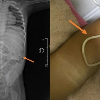Le dolía mucho la panza, fue al médico y descubrieron gusanos en su intestino 